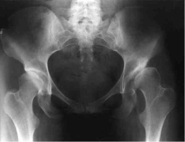 coxarthrose de l'articulation de la hanche à la radiographie