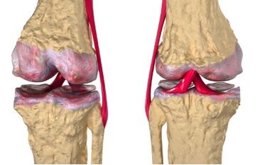 Varices du développement de la gonartrose