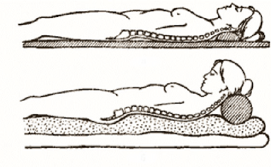Figure de l'ostéochondrose