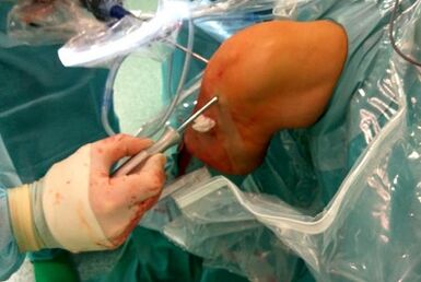 Chirurgie de l'arthrose