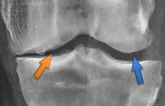 Kinesrunesapy pour l'arthrose