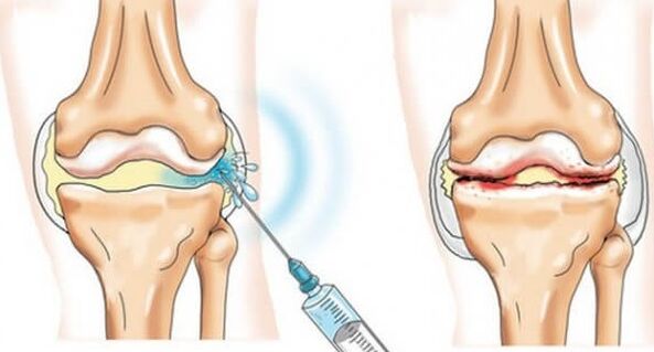 Mesures médicales de l'arthrose